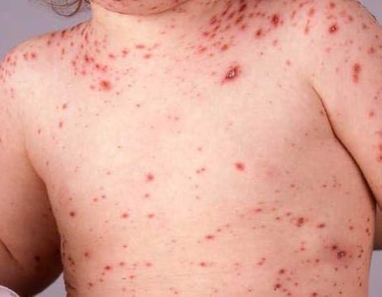 Епидемията от морбили в Македония все още не е приключила