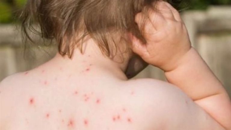 Епидемията от морбили в Македония взе първата жертва