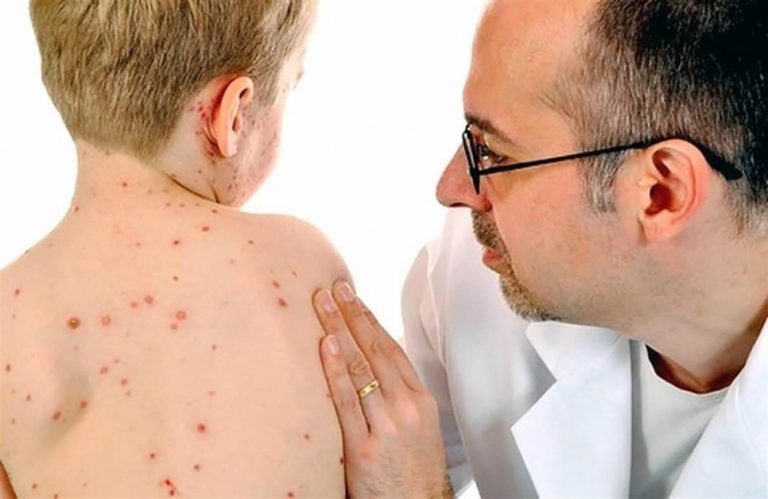 В Молдова е регистрирани 66 случая на морбили